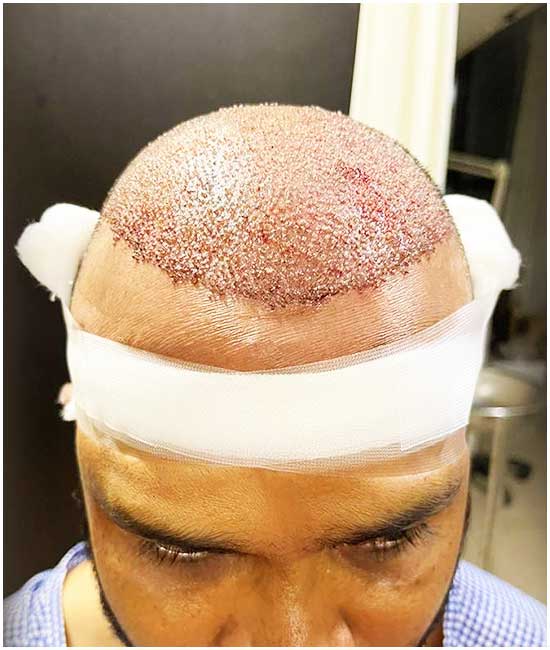 Follicular Unit Extraction (FUE)