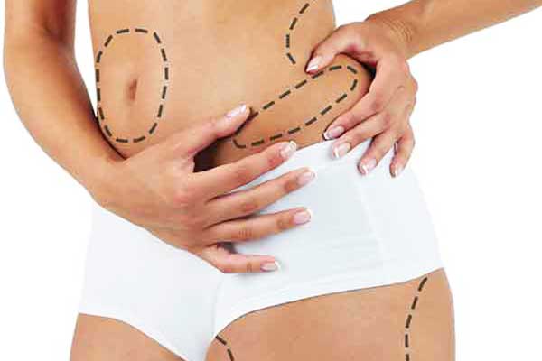 Laser-Assisted Liposuction