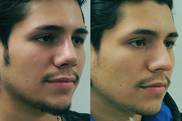 Nasenkorrektur bei Männern