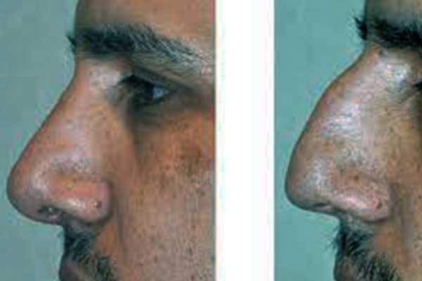 Roman Nose Rhinoplasty