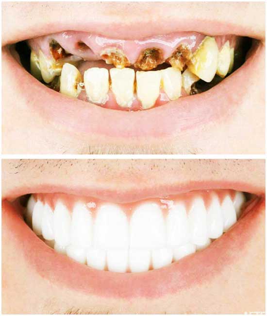 tandheelkundige implantaten
