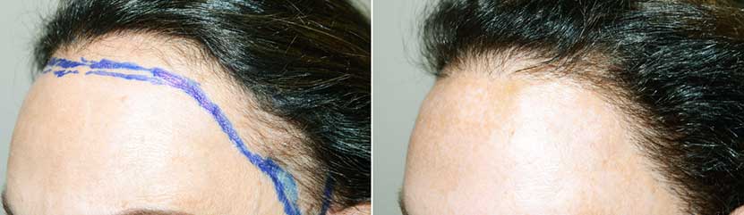 kvinnelig hårtransplantasjon