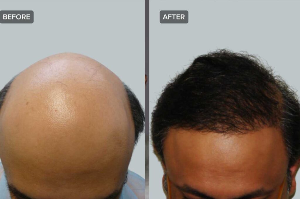 hårtransplantasjon