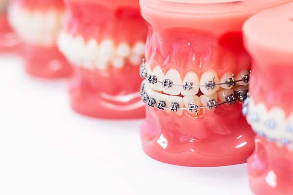Braces in Turkey: A Comprehensive Guide to Costs, Benefits, and Treatment Options