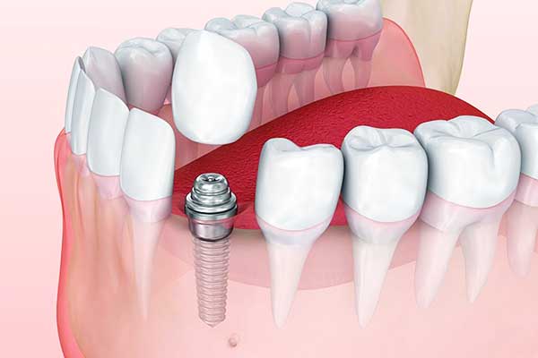Dental Implants Side Effects