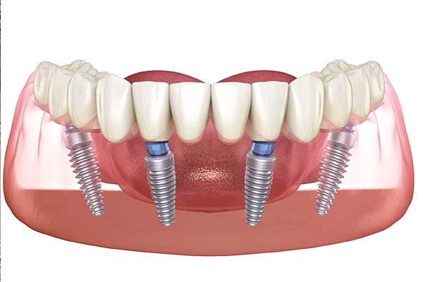 Dental Implants in Istanbul: Your Complete Guide