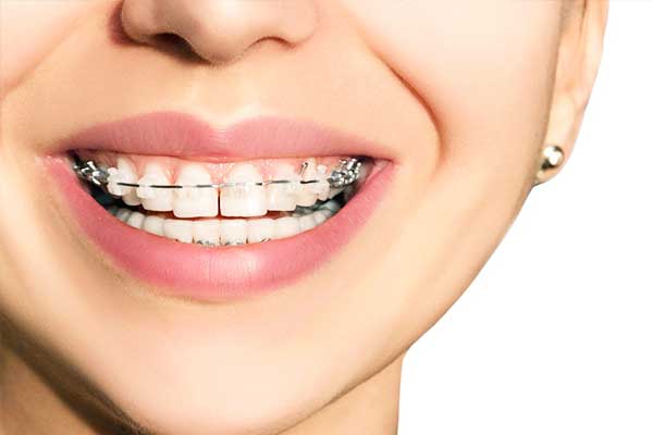 Fix Teeth Gap Without Braces: Comprehensive Solutions