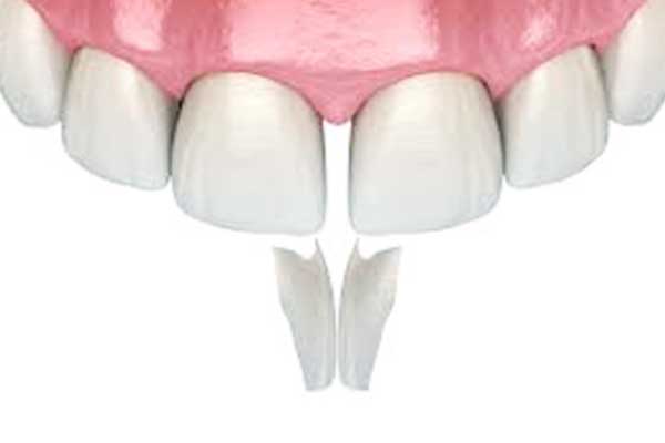 Front Teeth Bonding