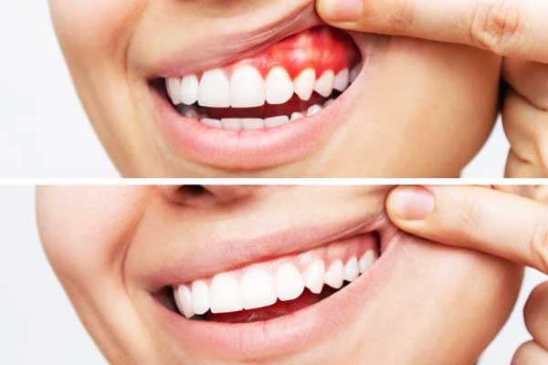 The Complete Guide to Gum Diseases: Prevention, Treatment, and Management