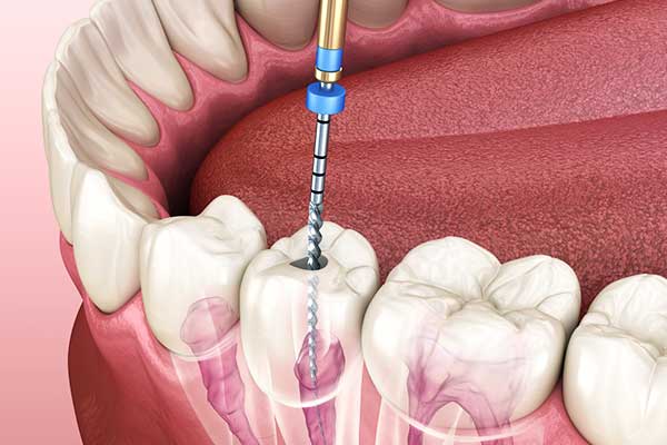 Everything You Need to Know About Root Canals: 10 Key Insights