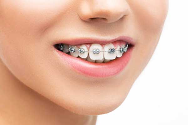 Teeth Straightening in Turkey