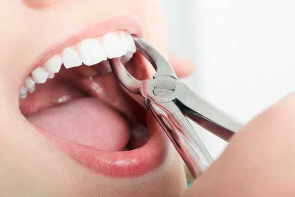The Ultimate Guide to Tooth Extraction: Everything You Need to Know