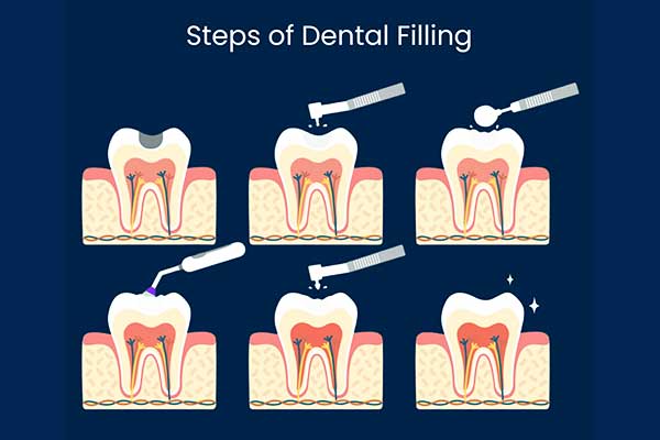 Everything You Need to Know About Tooth Fillings: Types, Costs, and Benefits