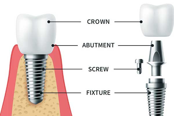 Tooth Implant Costs