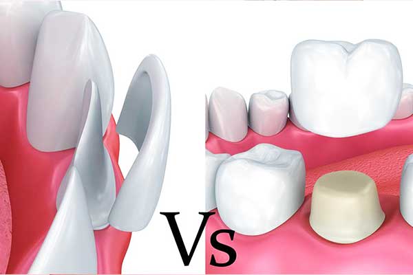 veneers vs crowns: A Comprehensive Guide to Choosing the Right Dental Solution