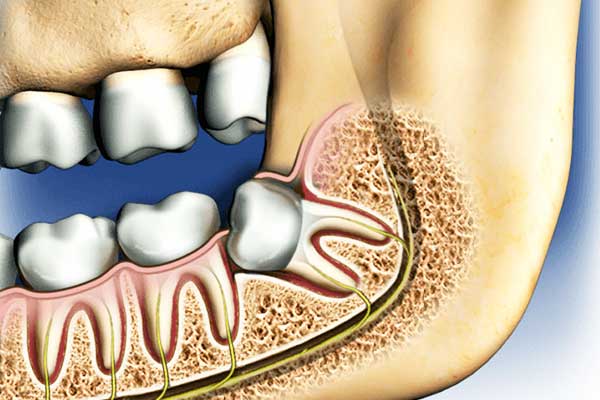 Wisdom Tooth Removal: Everything You Need to Know for a Smooth Recovery