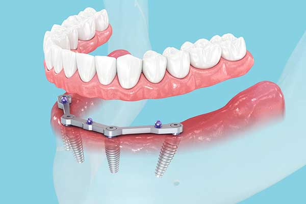 all on four dental implants: The Complete Guide