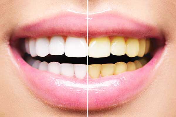 Discover the Best Teeth Whitening Solutions: A Comprehensive Guide
