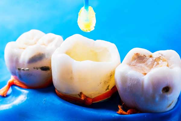 The Ultimate Guide to Composite Resin Bonding: Enhancing Your Smile with Modern Dentistry