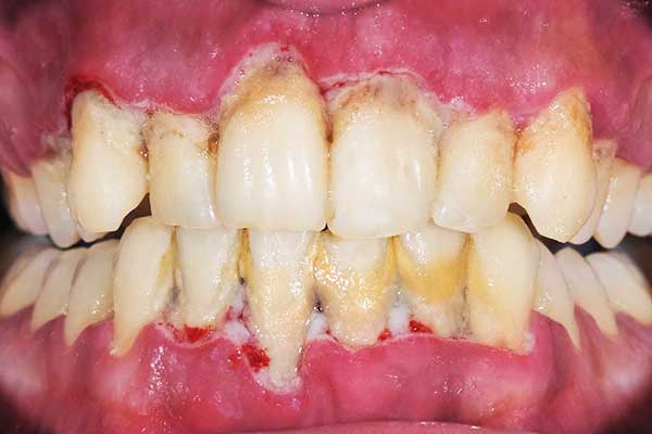 Understanding Periodontal Disease: Symptoms, Treatments, and Prevention