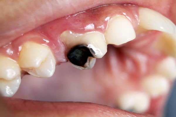 Understanding Silver Diamine Fluoride: An Innovative Solution for Tooth Decay