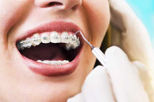 A Comprehensive Guide to Teeth Straightening: Options, Benefits, and FAQs