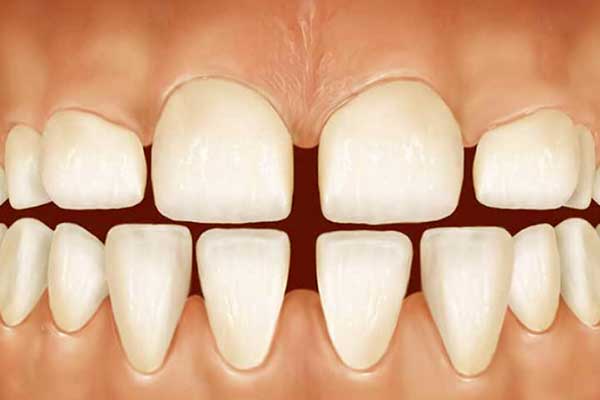 Crooked Teeth: Causes, Consequences, and Correction