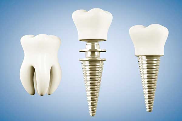 Top Implant Brands: Choosing the Best for Your Dental Needs