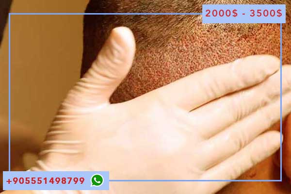 10 Причин для пересадка волос в стамбуле