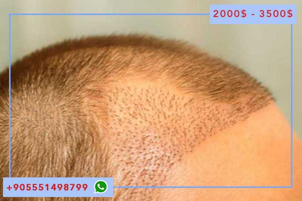 7 Плюсов и Минусов турция пересадка волос: Ваш Полный Гид с Ответами на Вопросы