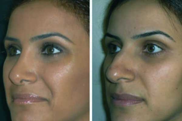 طرق لتجميل الأنف