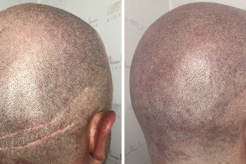 المناطق المانحة في زراعة الشعر