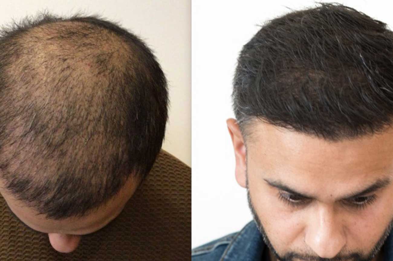 تقنية الاقتطاف الدقيق (Nano-FUE)