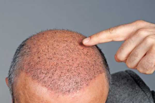 تكلفة زراعة الشعر