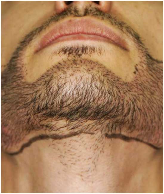 شروط زراعة الشعر