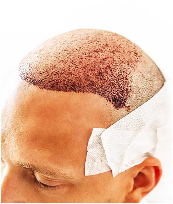 biofiber زراعة الشعر