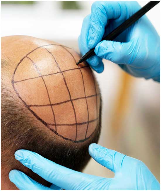 volden بديل زراعة الشعر