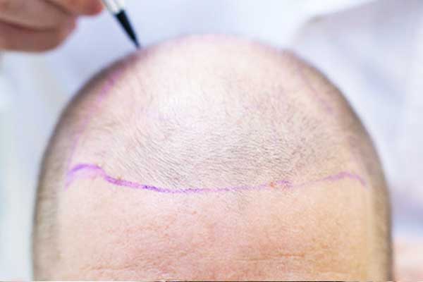 منتدى زراعة الشعر