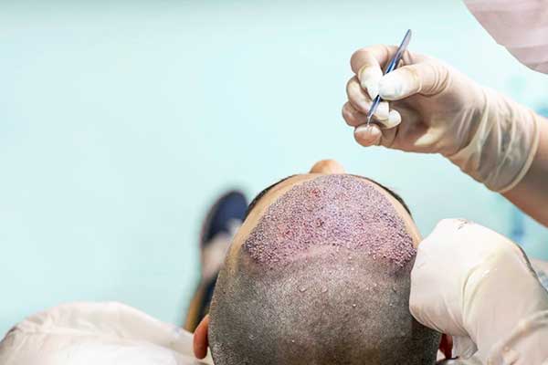 مضاعفات زراعة الشعر