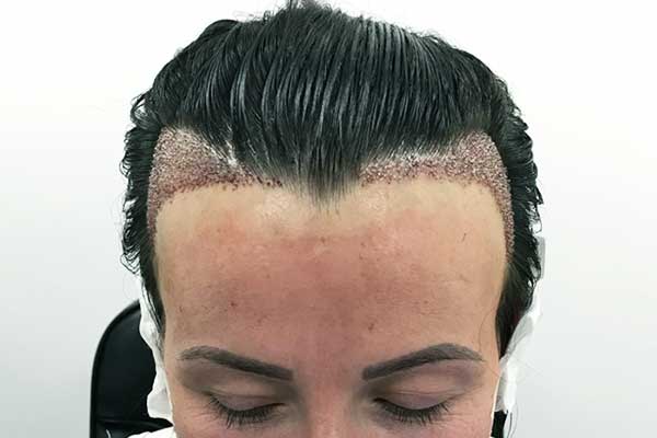 آخر الأبحاث عن تقنية زراعة الشعر بالاستنساخ