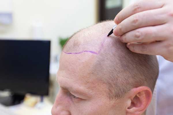 زراعة الشعر بالخلايا الجذعية