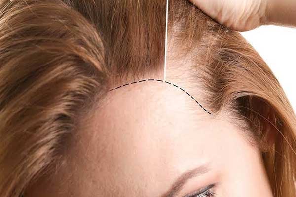 زراعة الشعر بدون حلاقة