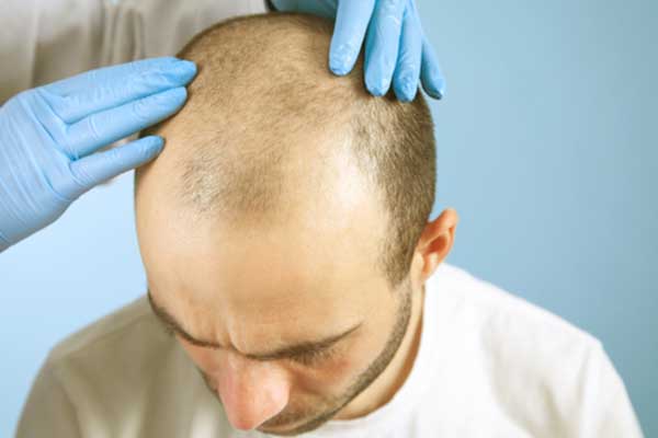 بديل زراعة الشعر