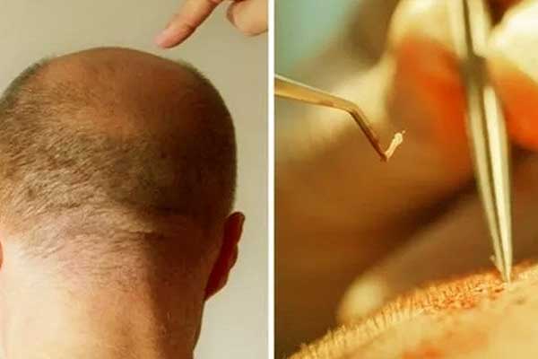 سعر عملية زراعة الشعر