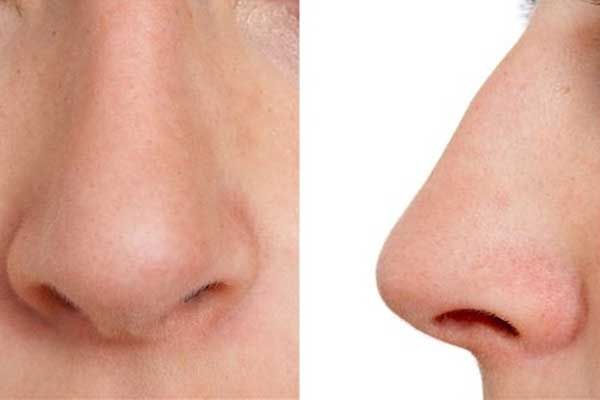 عمليات التجميل قبل وبعد للرجال