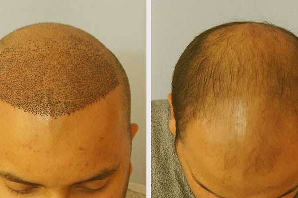 عمليات زراعة الشعر