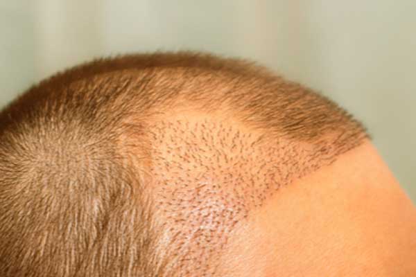 تجربتي مع زراعة الشعر