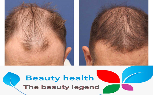 افضل مراكز زراعة الشعر في سوريا 2025: دليلك الشامل للحصول على أفضل النتائج