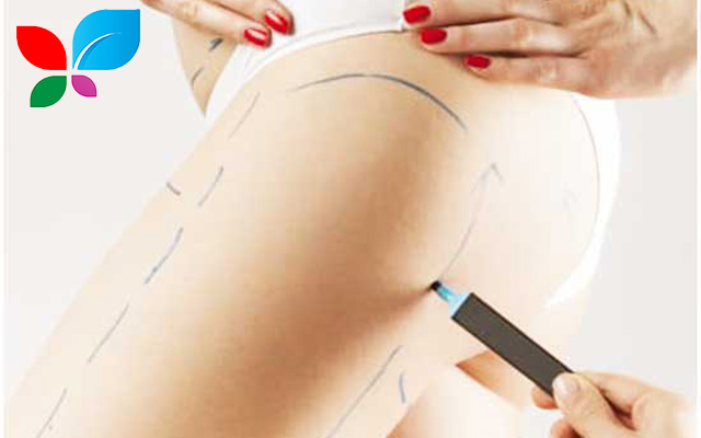 تجميل الأرداف في سوريا 2025: دليلك الكامل للحصول على الجسم المثالي بتقنيات عالمية وأسعار تنافسية