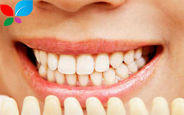 ابتسامة هوليود في سوريا: رحلتك نحو ابتسامة مثالية